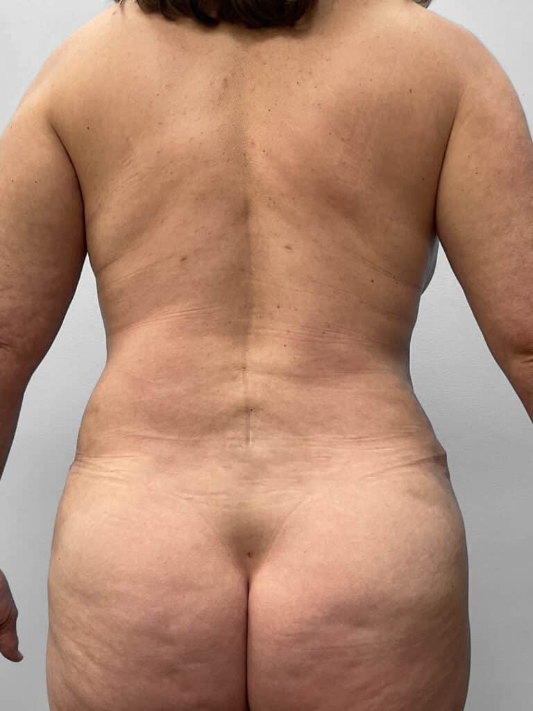 After Image: Abdominoplasty and Lipo- Dr. Tucker - back