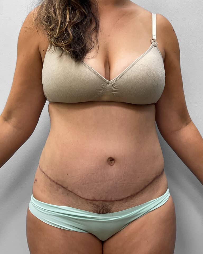 After Image: Abdominoplasty- Dr. Tucker - front