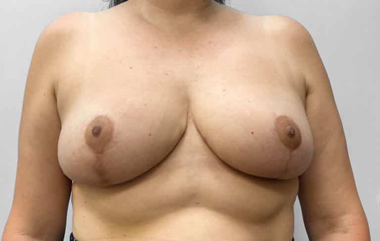 After Image: Breast Reduction- Dr. Howell - front