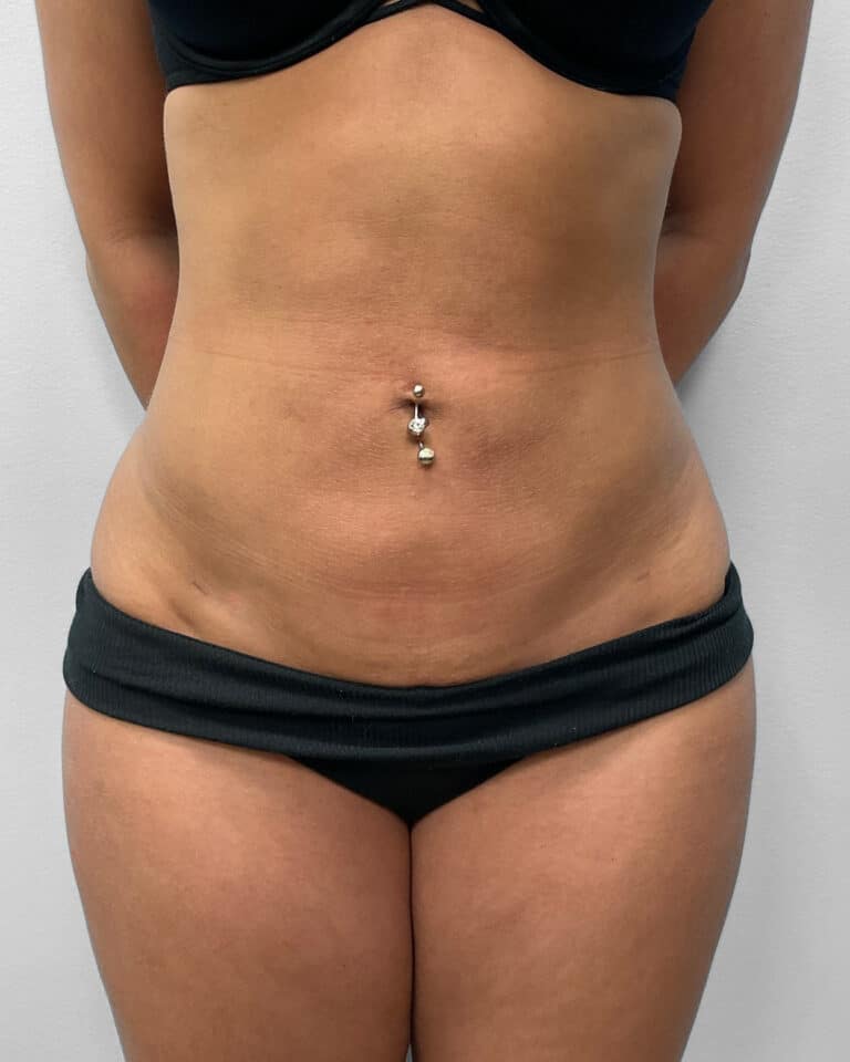 After Image: BBL & Liposuction- Dr. Howell - front