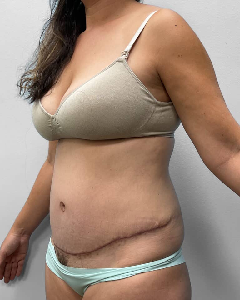 After Image: Abdominoplasty- Dr. Tucker - left-front-oblique