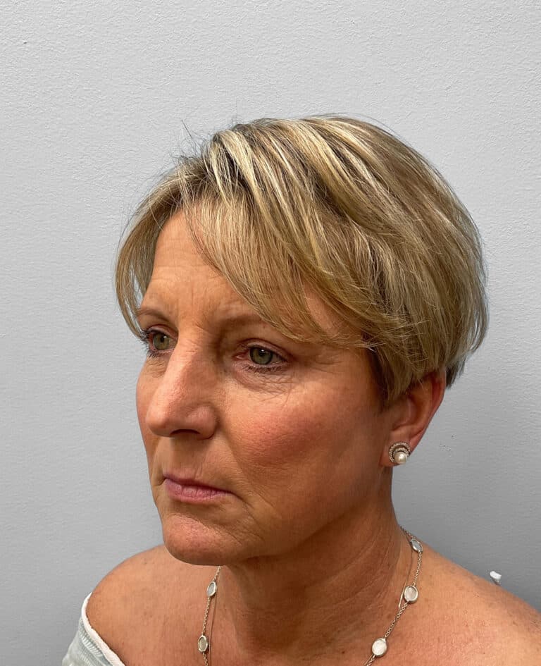 After Image: Blepharoplasty & Laser Resurfacing- Dr. Howell - left-front-oblique