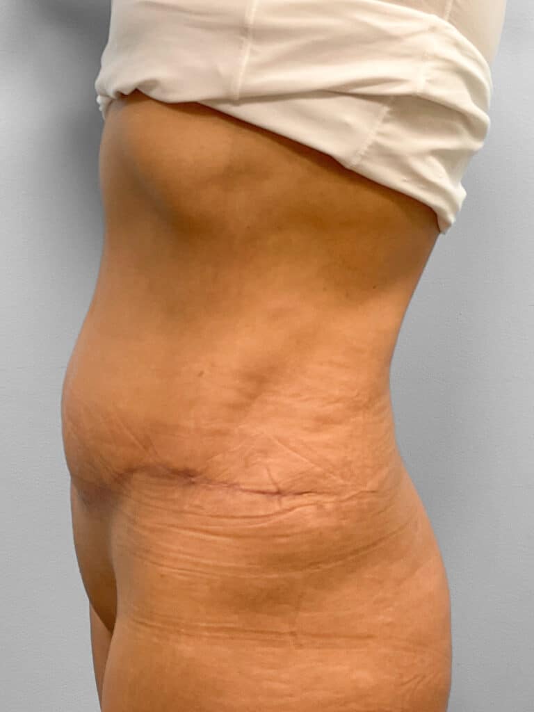 After Image: Abdominoplasty & Lipo- Dr. Tucker - left-side