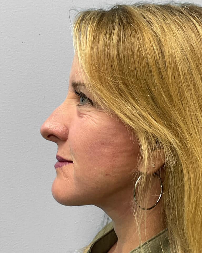 After Image: Facelift & TFX- Dr. Tucker - left-side