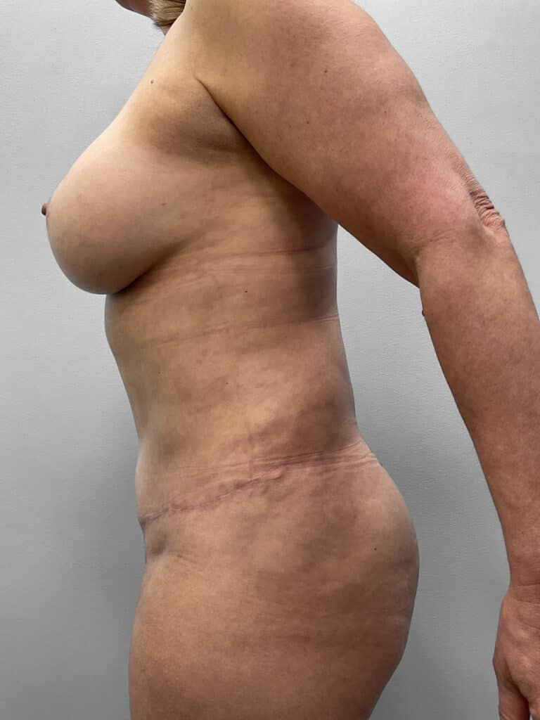 After Image: Abdominoplasty and Lipo- Dr. Tucker - left-side