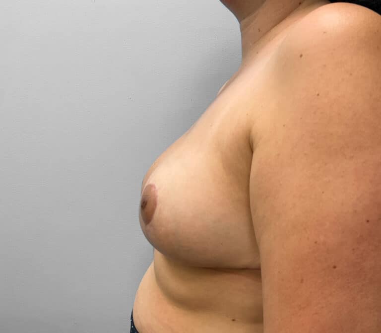 After Image: Breast Reduction- Dr. Howell - left-side