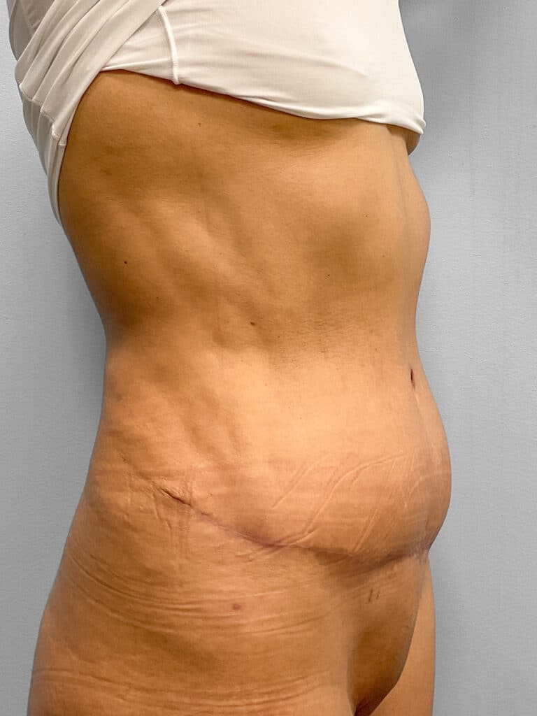 After Image: Abdominoplasty & Lipo- Dr. Tucker - right-front-oblique