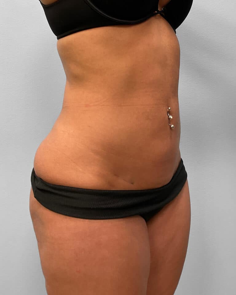 After Image: BBL & Liposuction- Dr. Howell - right-front-oblique