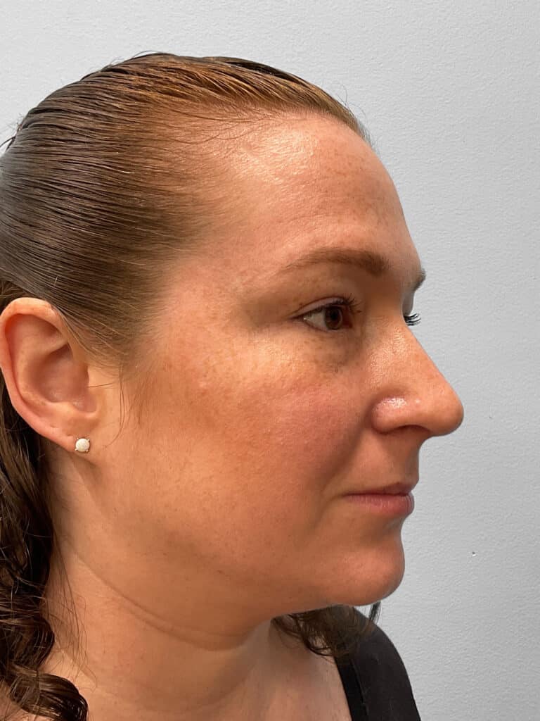 After Image: Rhinoplasty- Dr. Tucker - right-front-oblique