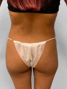 Before Image: Tummy Tuck, Lipo, & BBL- Dr. Tucker