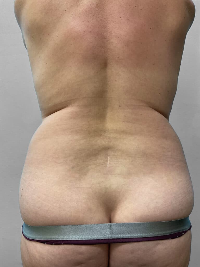 Before Image: Abdominoplasty and Lipo- Dr. Tucker - back