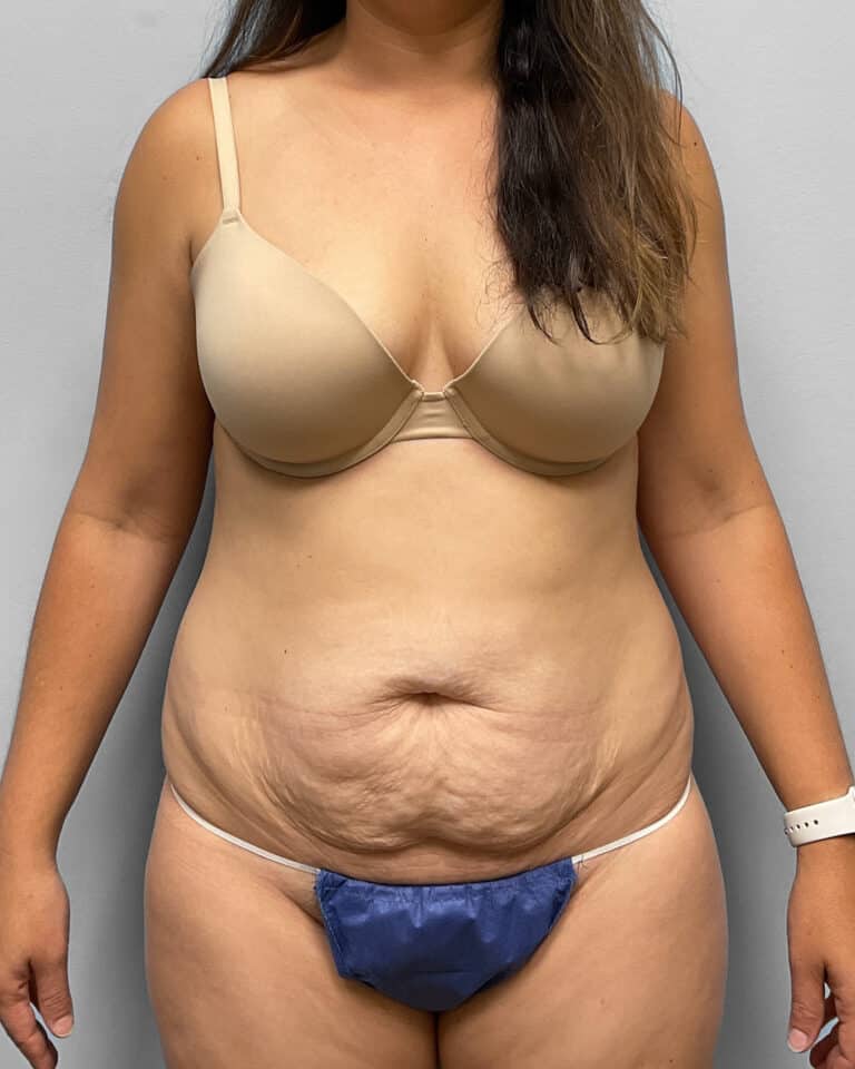 Before Image: Abdominoplasty- Dr. Tucker - front