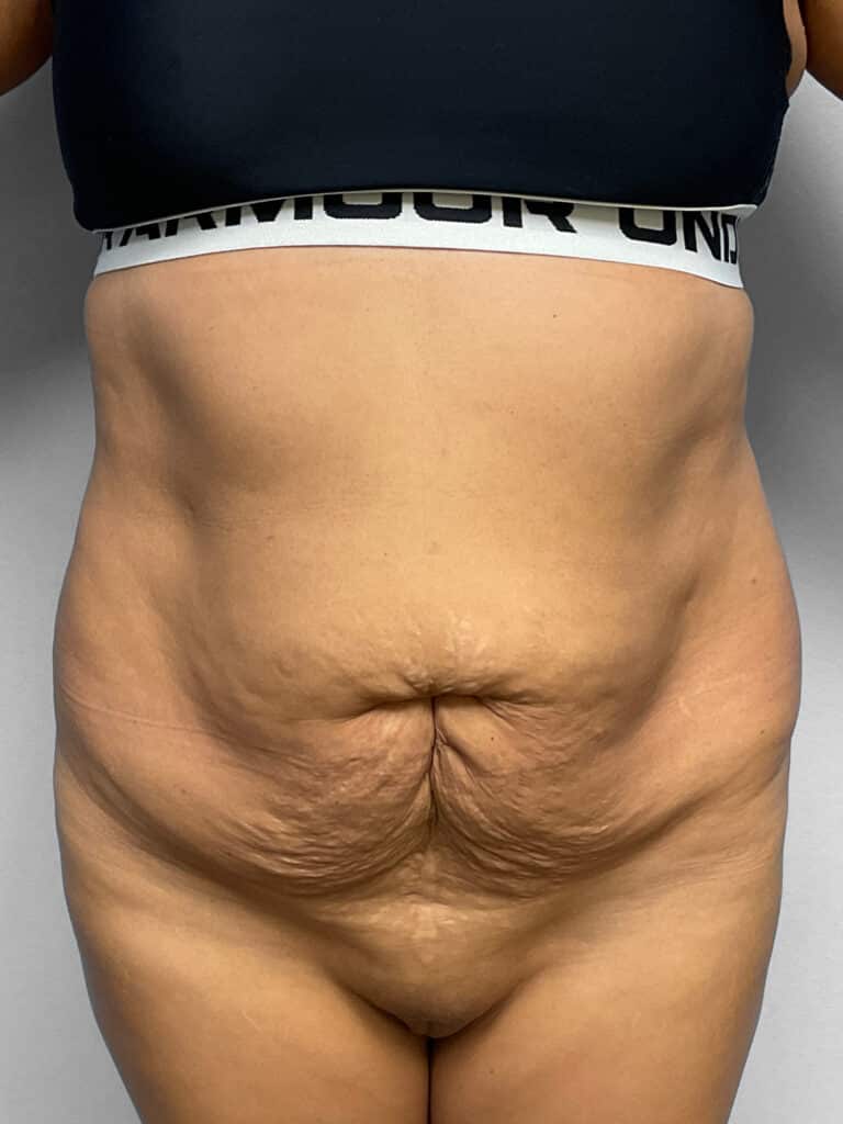 Before Image: Abdominoplasty & Lipo- Dr. Tucker - front