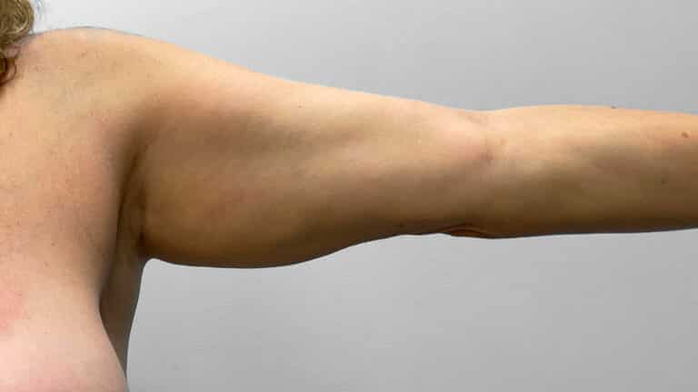 Before Image: Arm Lift- Dr. Tucker - left-side