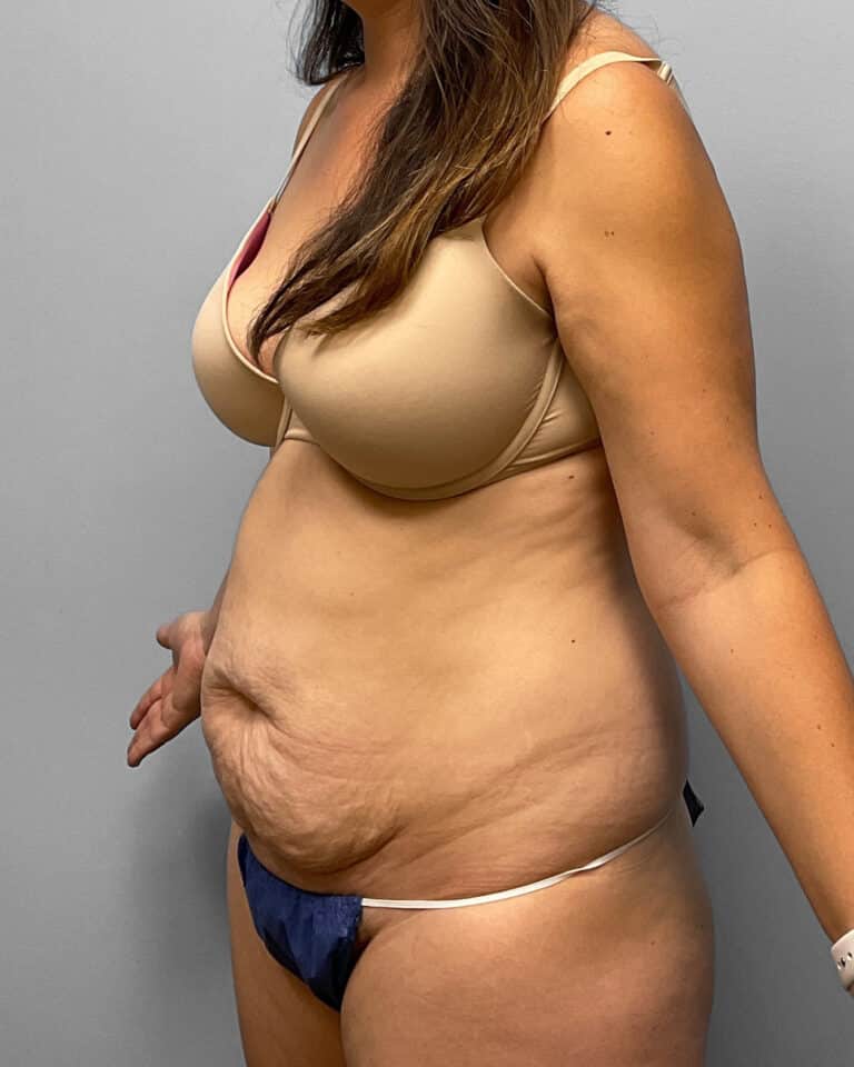 Before Image: Abdominoplasty- Dr. Tucker - left-front-oblique