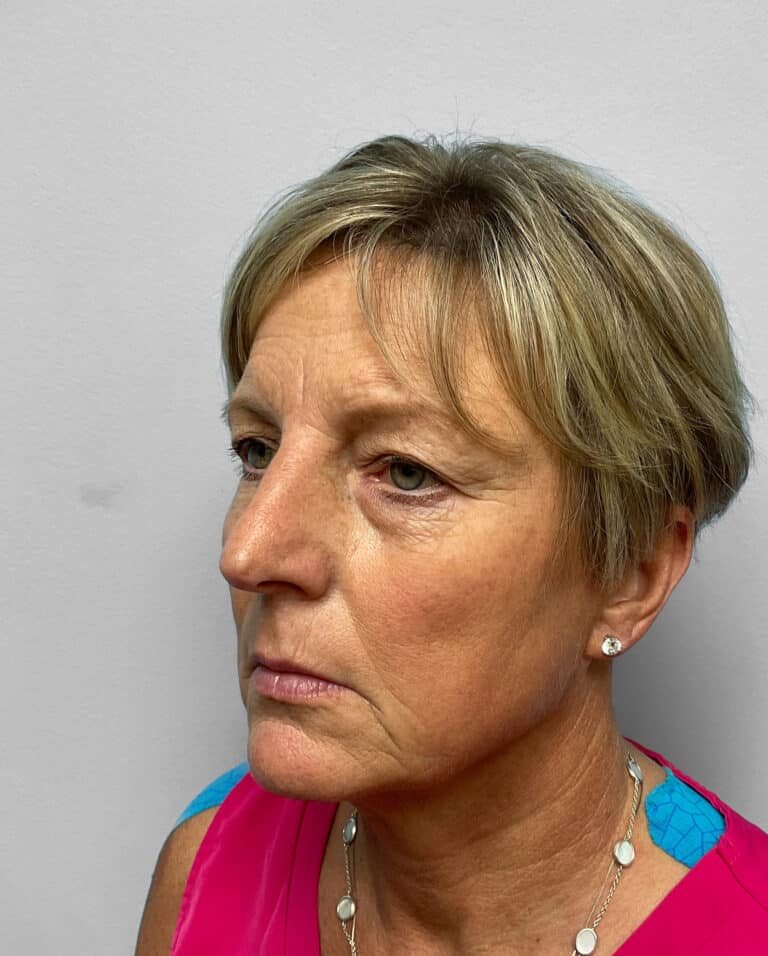 Before Image: Blepharoplasty & Laser Resurfacing- Dr. Howell - left-front-oblique