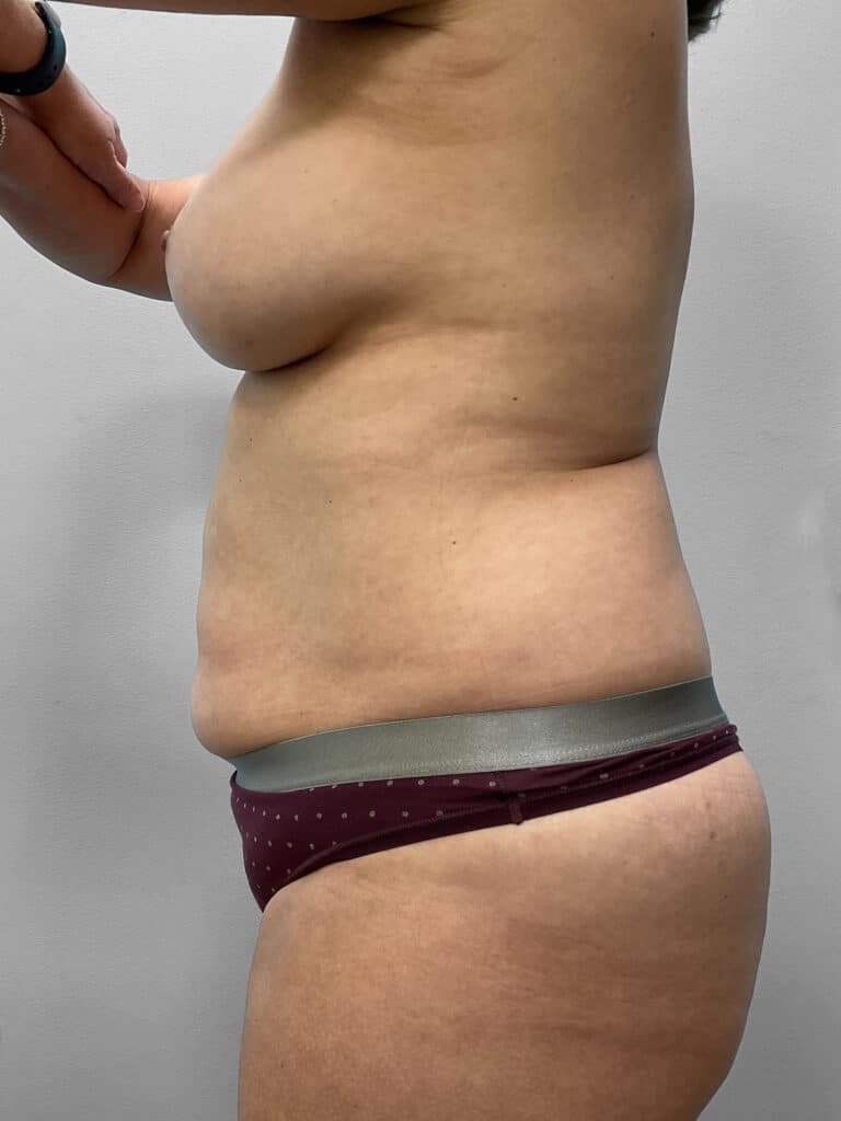 Before Image: Abdominoplasty and Lipo- Dr. Tucker - left-side