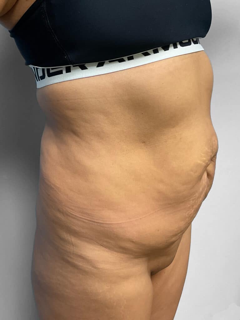 Before Image: Abdominoplasty & Lipo- Dr. Tucker - right-front-oblique