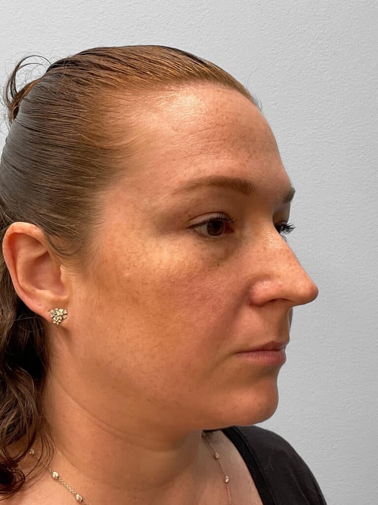 Before Image: Rhinoplasty- Dr. Tucker - right-front-oblique