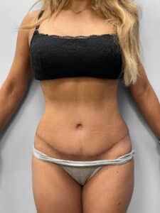 After Image: Tummy Tuck & Lipo- Dr. Howell