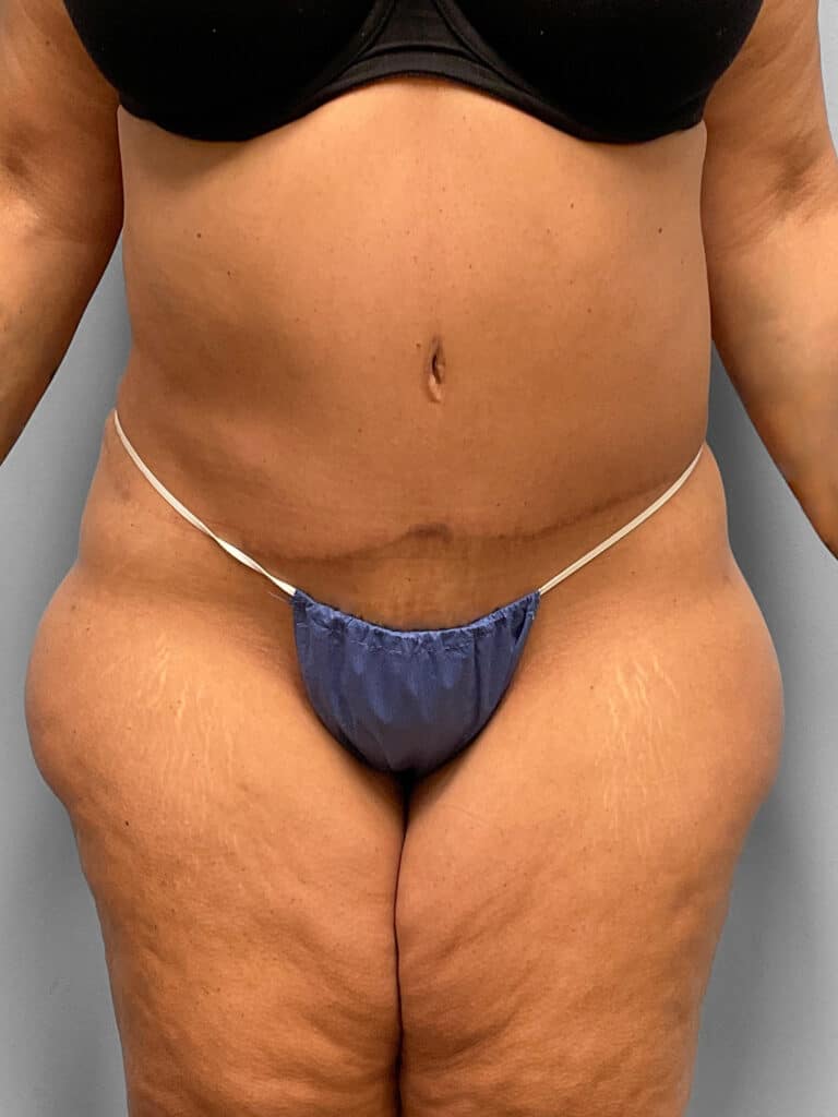 After Image: Abdominoplasty & 360 Lipo- Dr. Tucker - front