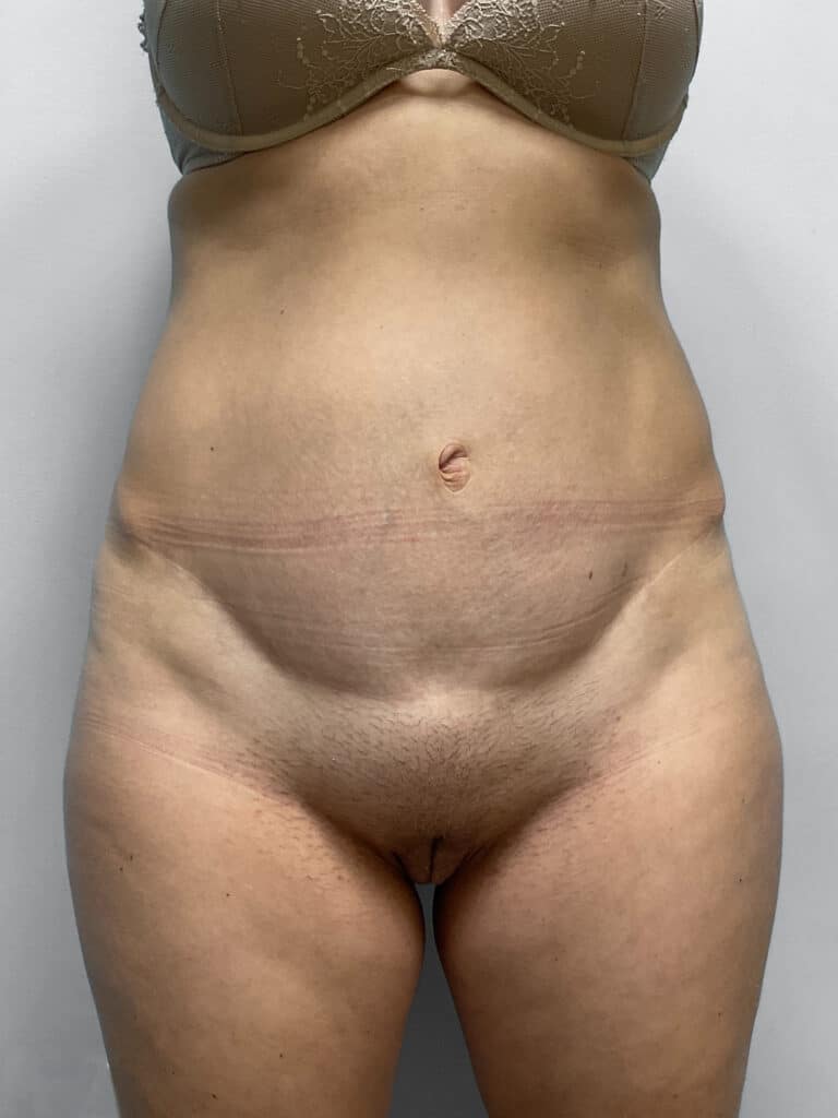 After Image: BBL, Thigh Lift & Lipo- Dr. Tucker - front