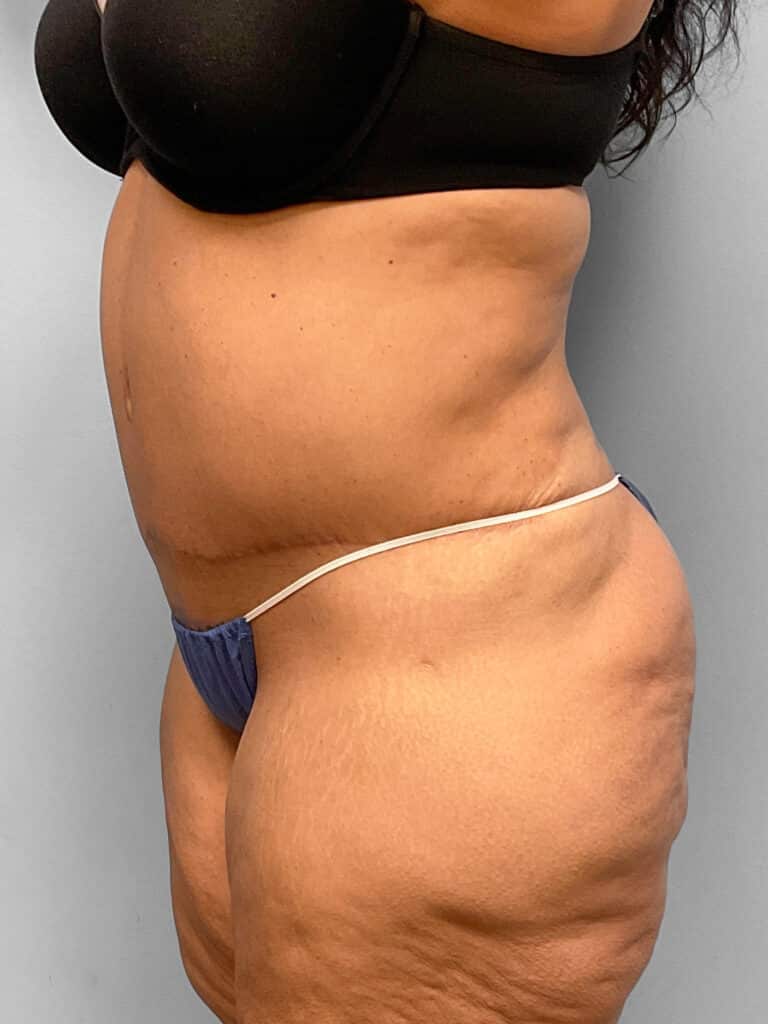 After Image: Abdominoplasty & 360 Lipo- Dr. Tucker - left-front-oblique