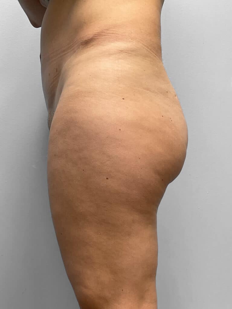 After Image: BBL, Thigh Lift & Lipo- Dr. Tucker - left-side