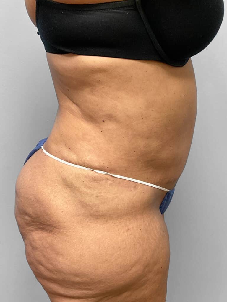 After Image: Abdominoplasty & 360 Lipo- Dr. Tucker - right-side