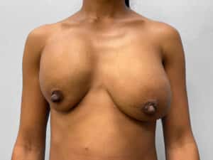 Before Image: Breast Implant Revision- Dr. Howell