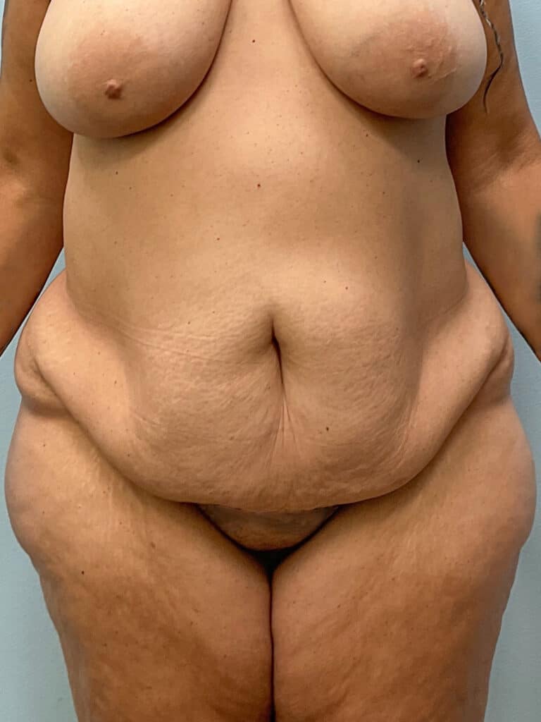 Before Image: Abdominoplasty & 360 Lipo- Dr. Tucker - front