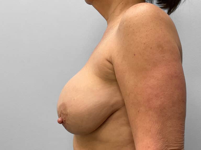 Before Image: Breast Implant Exchange- Dr. Tucker - left-side