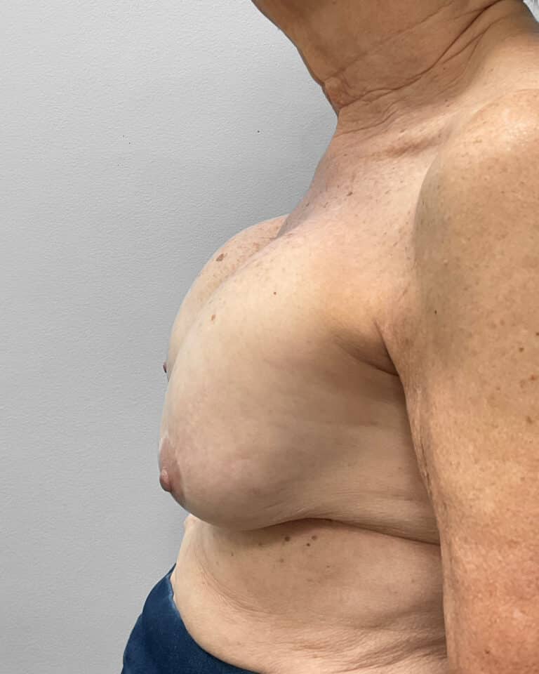 Before Image: Breast Lift & Implant Exchange- Dr. Howell - left-side