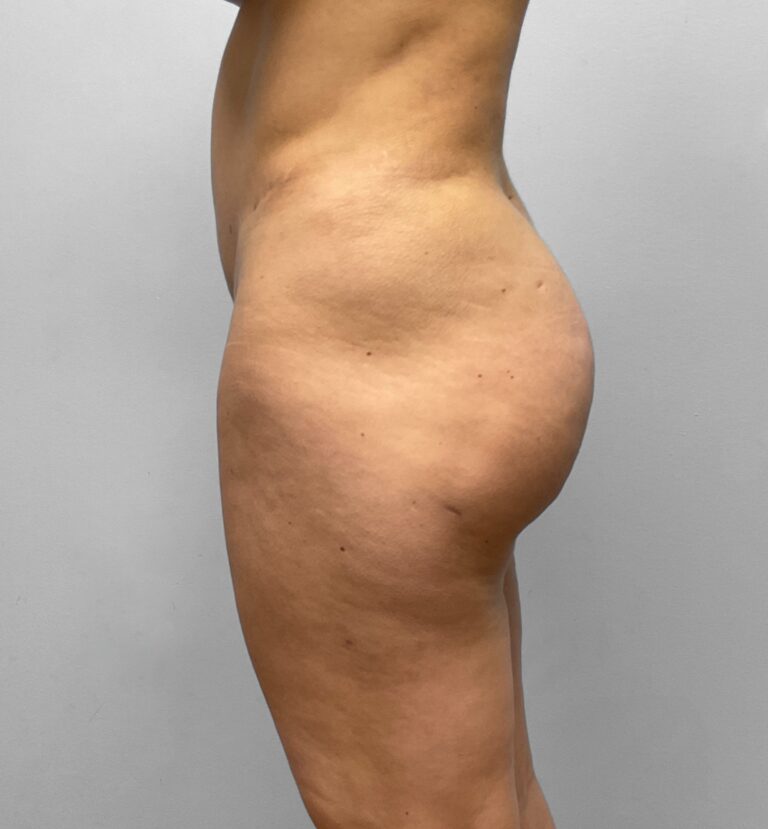 Before Image: BBL, Thigh Lift & Lipo- Dr. Tucker - left-side