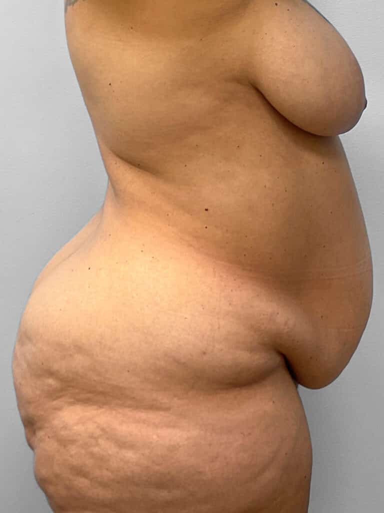 Before Image: Abdominoplasty & 360 Lipo- Dr. Tucker - right-side