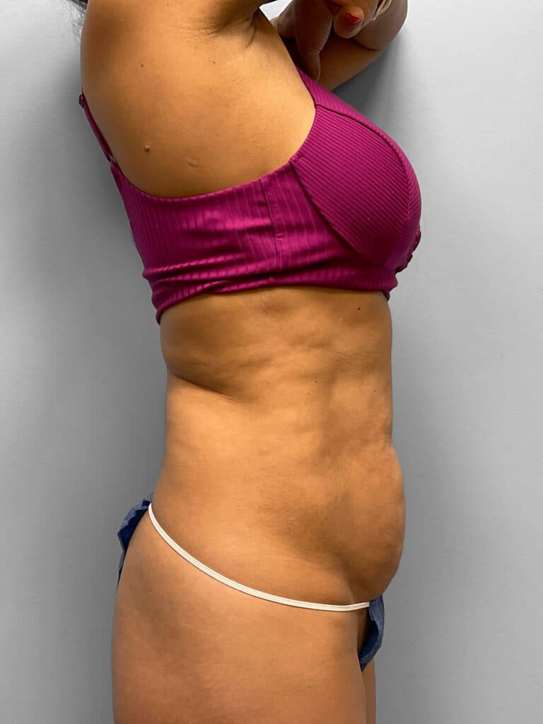 Before Image: Tummy Tuck & Lipo- Dr. Howell - right-side