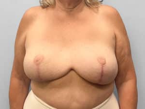 After Image: Breast Lift & Implant Removal – Dr. Tucker