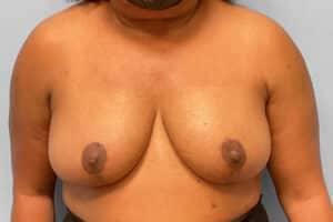 Breast Reduction – Dr. Tucker