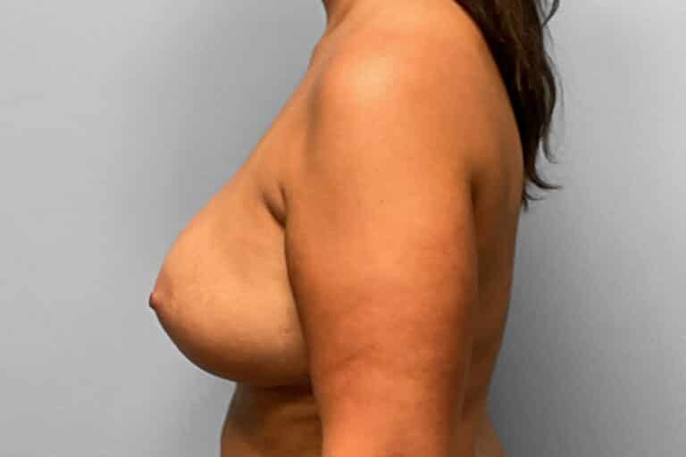 After Image: Breast Augmentation – Dr. Tucker - left-side