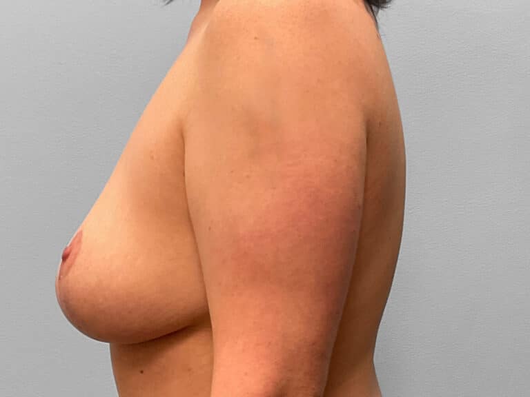 After Image: Breast Reduction – Dr. Tucker - left-side