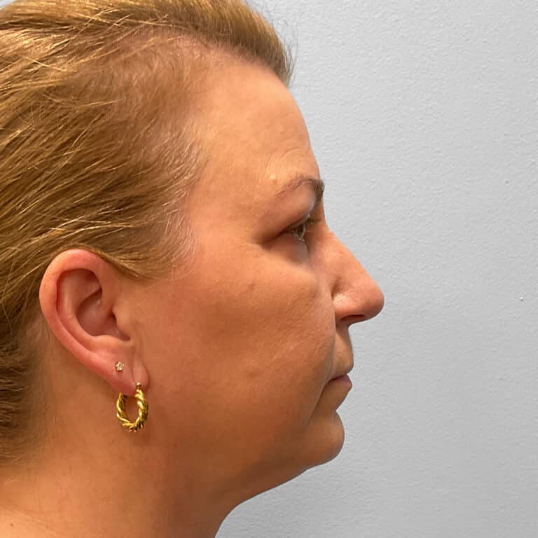 After Image: Upper and Lower Blepharoplasty – Dr. Tucker - right-side