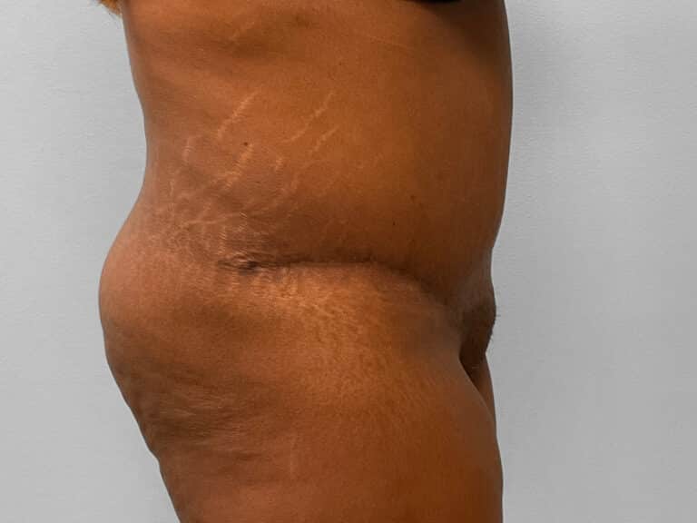 After Image: Tummy Tuck & Lipo – Dr. Tucker - right-side