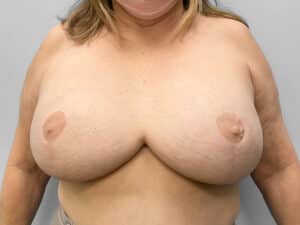 Before Image: Breast Lift & Implant Removal – Dr. Tucker