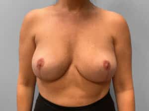 After Image: Breast Lift & Implant Removal – Dr. Tucker