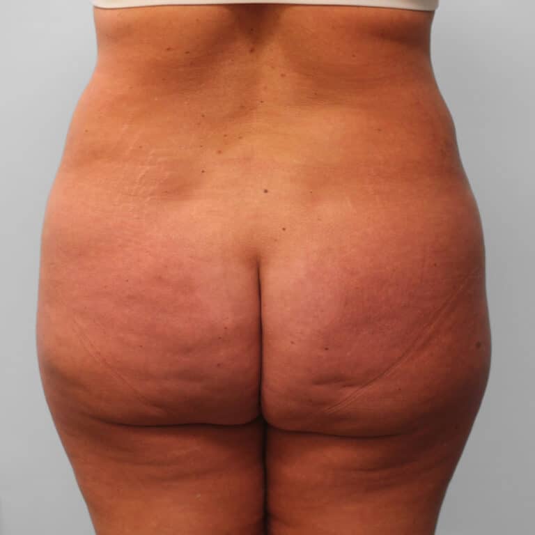 After Image: Tummy Tuck & Lipo – Dr. Tucker - back