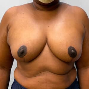 After Image: Breast Augmentation – Dr. Tucker