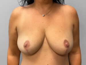 After Image: Breast Reduction – Dr. Tucker