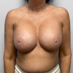 After Image: Breast Augmentation – Dr. Tucker