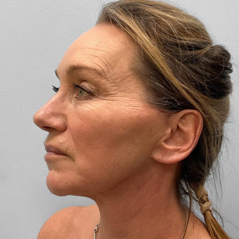 After Image: Facelift & TFX – Dr. Tucker - left-front-oblique