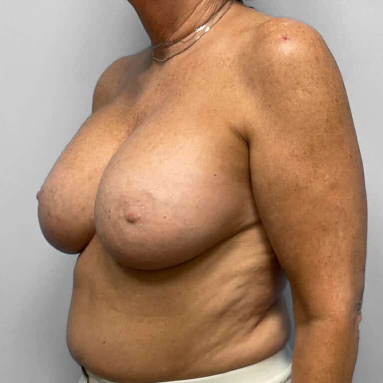 After Image: Breast Augmentation – Dr. Tucker - left-front-oblique